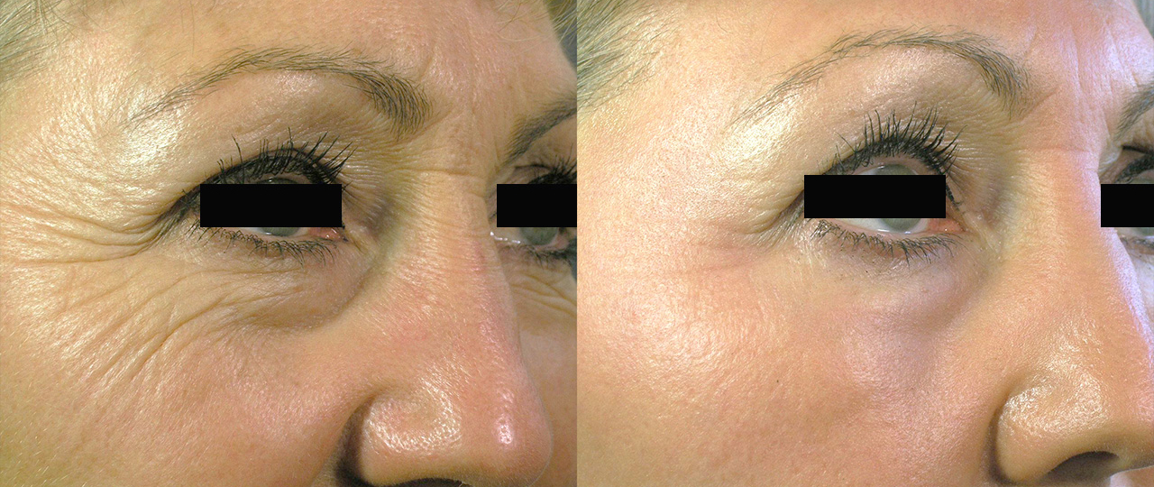 Non Ablative Skin Resurfacing Before & After